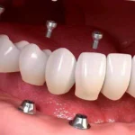 باید ها و نباید های ایمپلنت