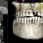بایدها و نباید های ایمپلنت (قسمت سوم)
