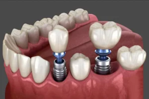 ایمپلنت دندان