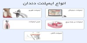 ایمپلنت دندان
