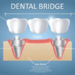 انواع بریج دندان و مقایسه آن‌ها همراه با برندهای معتبر
