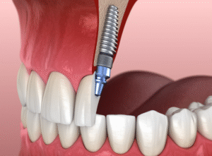 ایمپلنت دندان