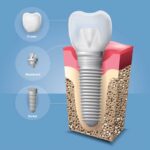 انواع روش‌های کاشت دندان