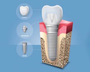 ایمپلنت دندان