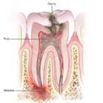 درمان ریشه دندان فقط برای درد نیست | تأثیر احتمالی بر سلامت قلب و قند خون
