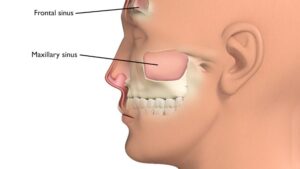 سینوس ماگزیلاری و ارتباط آن با دندان های خلفی